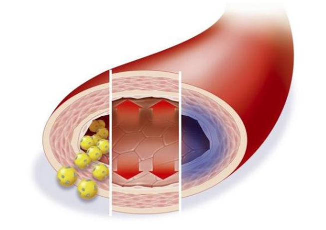 低密度膽固醇超標(biāo)，多久會(huì)影響血管健康？來看看鹽城康復(fù)醫(yī)院醫(yī)生怎么說